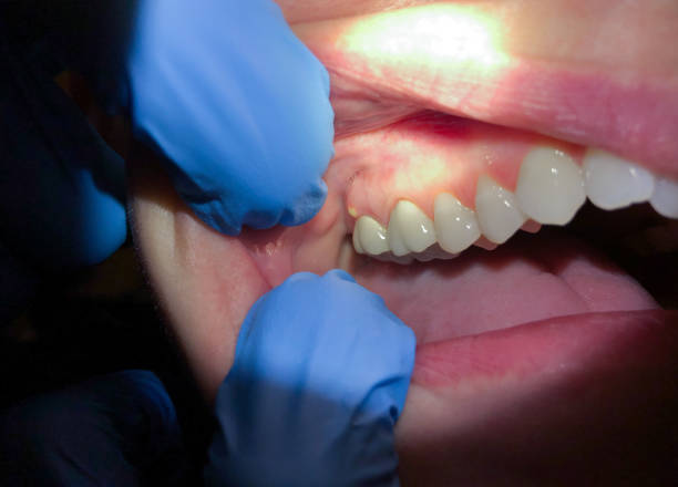 Best Emergency Dentist for Knocked-Out Tooth in Lampeter, PA